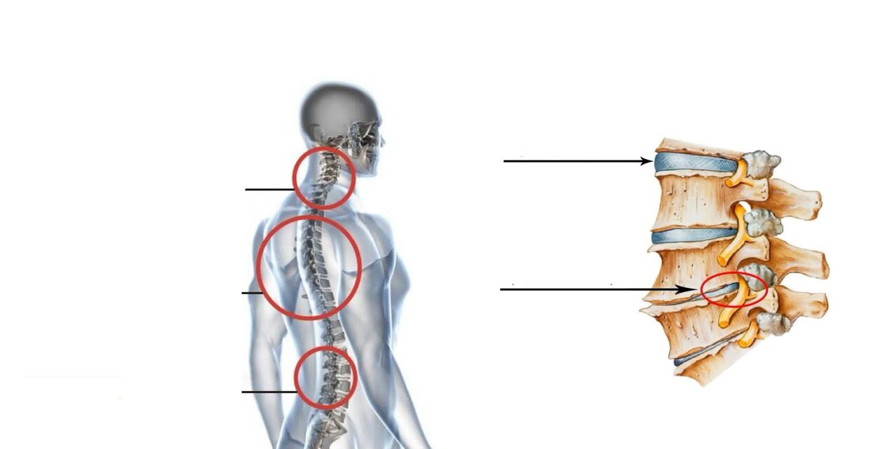 Osteochondrosis neck treatment